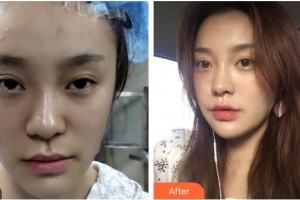 臺州市立醫(yī)院燒傷整形外科魯繼增整形價格表附埋線提升案例展示