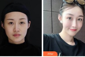 臺州市立醫(yī)院燒傷整形外科時述黨整形價格表附埋線提升案例展示