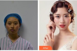 臺州市中心醫(yī)院整形美容科陶革方整形價格表附埋線提升案例展示