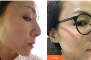 臺州維多利亞整形美容醫(yī)院張曉娟整形價格表附埋線提升案例展示