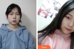 臺州博雅美惠醫(yī)療美容整形醫(yī)院張艷整形價格表附埋線提升案例展示