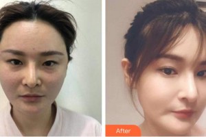 臺州博雅美惠醫(yī)療美容整形醫(yī)院李影影整形價格表附埋線提升案例展示