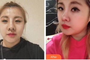 臺州愛美美萊醫(yī)療美容門診部吳應凱整形價格表附熱瑪吉案例展示