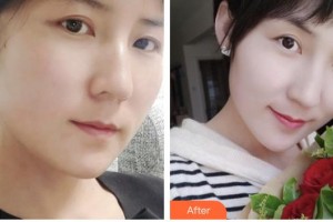 臺(tái)州愛(ài)美美萊醫(yī)療美容門診部林怡欣整形價(jià)格表附埋線提升案例展示