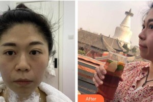 臺(tái)州愛(ài)美美萊醫(yī)療美容門診部趙德明整形價(jià)格表附熱瑪吉案例展示