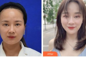 臺(tái)州仁登醫(yī)療美容門診部陳道明整形價(jià)格表附埋線提升案例展示