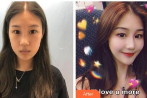 臺(tái)州蘭天醫(yī)療美容診所張殷整形價(jià)格表附眼部綜合案例展示