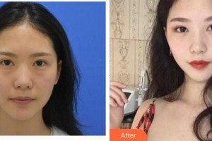 臺(tái)州恩璨醫(yī)療美容門診部曠健整形價(jià)格表附激光去眼袋案例展示