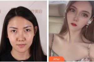 臺(tái)州韓爾口腔門診部郟海江整形價(jià)格表附切開(kāi)雙眼皮案例展示