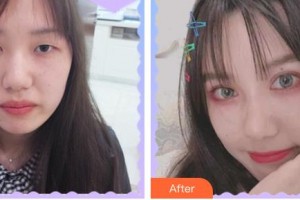 臺(tái)州國(guó)際眼科醫(yī)院黃小明整形價(jià)格表附開(kāi)內(nèi)眼角案例展示