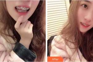 臺(tái)州韓爾口腔門診部陳學(xué)良整形價(jià)格表附金屬托槽矯正案例展示