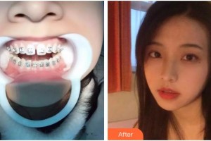 臺(tái)州牙博士口腔門診部劉丹旭整形價(jià)格表附隱形托槽矯正案例展示