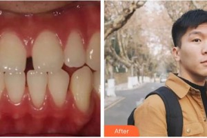 臺(tái)州牙科醫(yī)院林松整形價(jià)格表附金屬托槽矯正案例展示