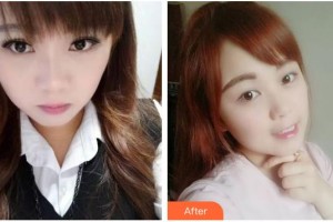 臺(tái)州牙科醫(yī)院許麗霞整形價(jià)格表附牙齒隱形矯正案例展示