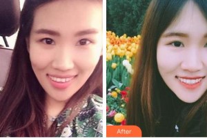 臺(tái)州牙科醫(yī)院金文軍整形價(jià)格表附牙齒隱形矯正案例展示