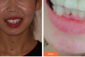 臺(tái)州牙科醫(yī)院黃凌凌整形價(jià)格表附牙齒隱形矯正案例展示