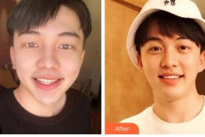 臺(tái)州牙科醫(yī)院陳慧整形價(jià)格表附美白貼片案例展示