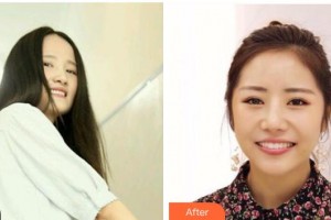 臺州拜博口腔醫(yī)院王越整形價格表附牙齒隱形矯正案例展示