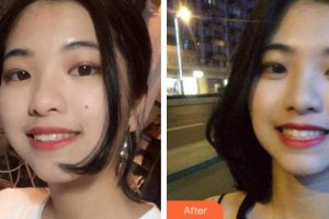 臺州康貝佳口腔醫(yī)院蔡騎兵整形價格表附牙齒隱形矯正案例展示