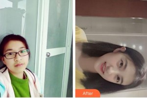 臺州康貝佳口腔醫(yī)院宋文斯整形價格表附金屬托槽矯正案例展示