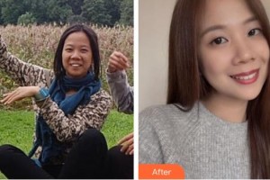 臺州貝雅口腔醫(yī)院羅剛整形價格表附金屬托槽矯正案例展示