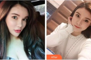 臺州貝雅口腔醫(yī)院史佩強整形價格表附超聲波潔牙案例展示