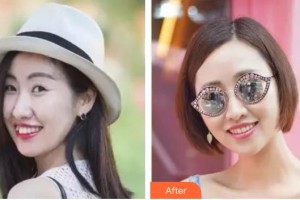 臺州牙博士口腔門診部梁星天整形價格表附隱形托槽矯正案例展示