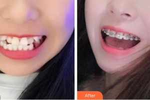 臺州牙博士口腔門診部簡小沖整形價格表附金屬托槽矯正案例展示