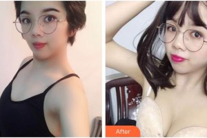 臺州市第一人民醫(yī)院醫(yī)療美容科張勇整形價格表附自體脂肪隆胸案例展示