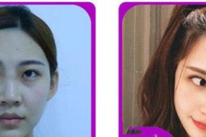 臺州愛爾眼科醫(yī)院張曉整形價格表附眼部綜合案例展示