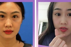 臺州市第一人民醫(yī)院醫(yī)療美容科程茜整形價格表附激光去眼袋案例展示