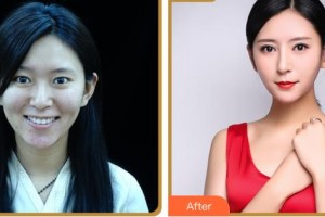 臺州國際眼科醫(yī)院葉正輝整形價格表附眼部綜合案例展示