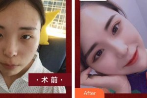 臺州國際眼科醫(yī)院汪凌整形價格表附埋線雙眼皮案例展示