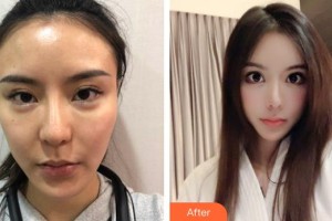 臺州國際眼科醫(yī)院崔樂樂整形價格表附下瞼整形案例展示