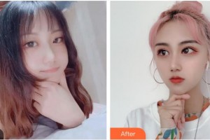 臺州國際眼科醫(yī)院宋慧洋整形價格表附眼部綜合案例展示