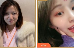 臺州國際眼科醫(yī)院卓佐跑整形價格表附眼部綜合案例展示