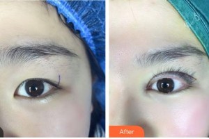 臺(tái)州國際眼科醫(yī)院沈咲整形價(jià)格表附眼部綜合案例展示