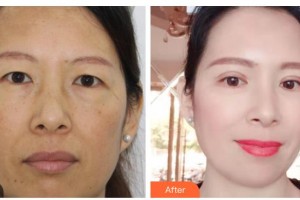 臺(tái)州國際眼科醫(yī)院王肖整形價(jià)格表附切開雙眼皮案例展示