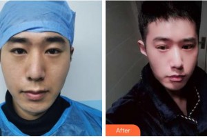 臺(tái)州國際眼科醫(yī)院王毓琴整形價(jià)格表附眼部綜合案例展示