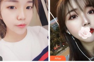 臺(tái)州國際眼科醫(yī)院趙澤林整形價(jià)格表附切開雙眼皮案例展示