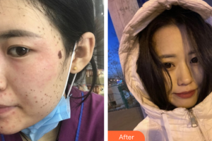 深圳美芮（原雅唯）醫(yī)療美容門診部呂方中整形價格表附超激光美膚祛斑案例展示