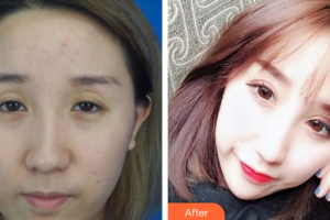 深圳美芮（原雅唯）醫(yī)療美容門診部羅凱整形價格表附切開雙眼皮案例展示