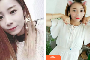 深圳美芮（原雅唯）醫(yī)療美容門診部諶貽進(jìn)整形價格表附冷光美白案例展示