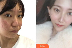 深圳博愛醫(yī)院整形美容中心朱建生整形價格表附祛痘美白案例展示