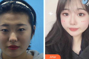 深圳韓美爾醫(yī)療美容門診部賈章明整形價格表附埋線雙眼皮案例展示