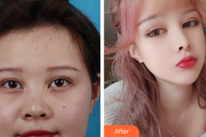 深圳銘醫(yī)醫(yī)療美容醫(yī)院裴南錫整形價格表附耳軟骨鼻部手術(shù)案例展示