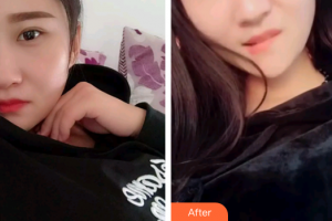 深圳銘醫(yī)醫(yī)療美容醫(yī)院于秀英整形價格表附根管調(diào)節(jié)案例展示