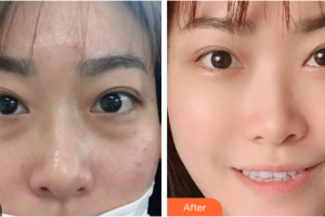 深圳悅己醫(yī)療美容醫(yī)院趙廣慶整形價格表附去眼袋案例展示