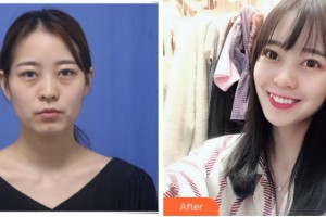 臺(tái)州國際眼科醫(yī)院鄭欽象整形價(jià)格表附激光去眼袋案例展示