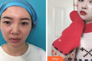 臺(tái)州國際眼科醫(yī)院馬慧香整形價(jià)格表附眼部修復(fù)案例展示